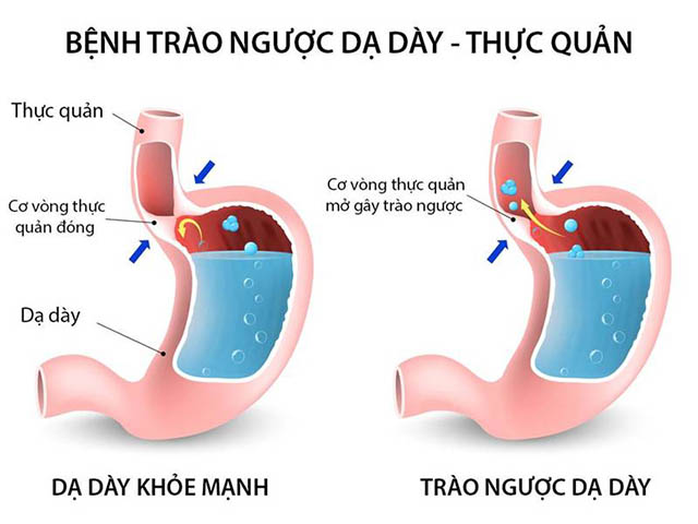 may loc nuoc dien giai kangen