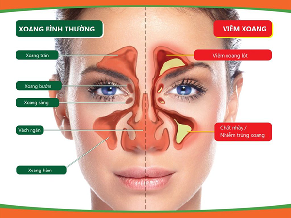 trị viêm xoang với nước kangen