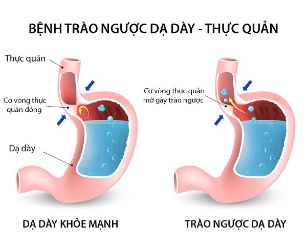Các bệnh về hệ tiêu hóa