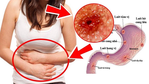 Các bệnh về hệ tiêu hóa