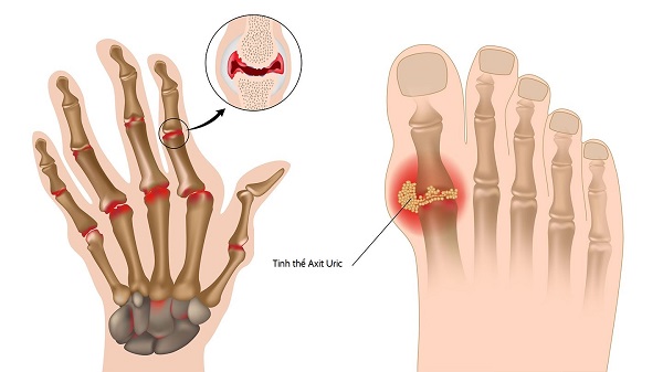 Nước kiềm và bệnh Gout - Điều trị hiệu quả